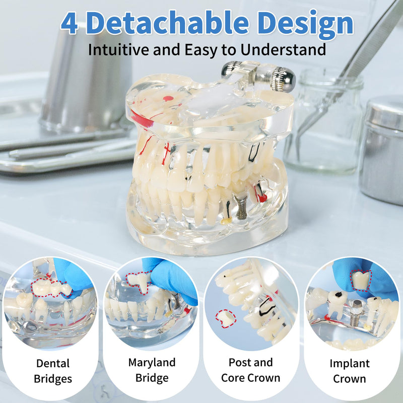 Annhua Transparent Disease Teeth Model for Dental Students, 32 Standard Removable Typodont Teeth Pathological Teaching Model - Ideal for Teaching, Not for Clinical Use Standard-Transparent Teeth Model - BeesActive Australia