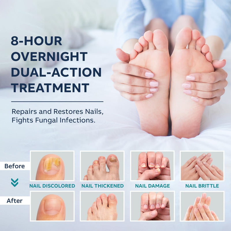 Toenail Fungus Treatment Extra Strength Kit: Nail Repair Liquid Solution and Patches - Nighttime Nail Patches Renewal - Fast Acting Drops with Undecylenic Acid, Natural Oil for Toe Finger Nails mint 1 Fl Oz (Pack of 1) - BeesActive Australia