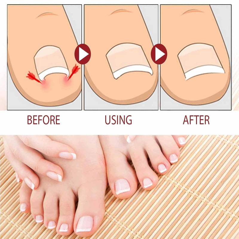 Nail Fungus Treatment Gel, Natural Nail Repair Care Gel, Nail Oil for Growth & Strength, Nail Growth Serum, Strengthening Cuticle Serum - 2pcs 0.1 Fl Oz (Pack of 2)