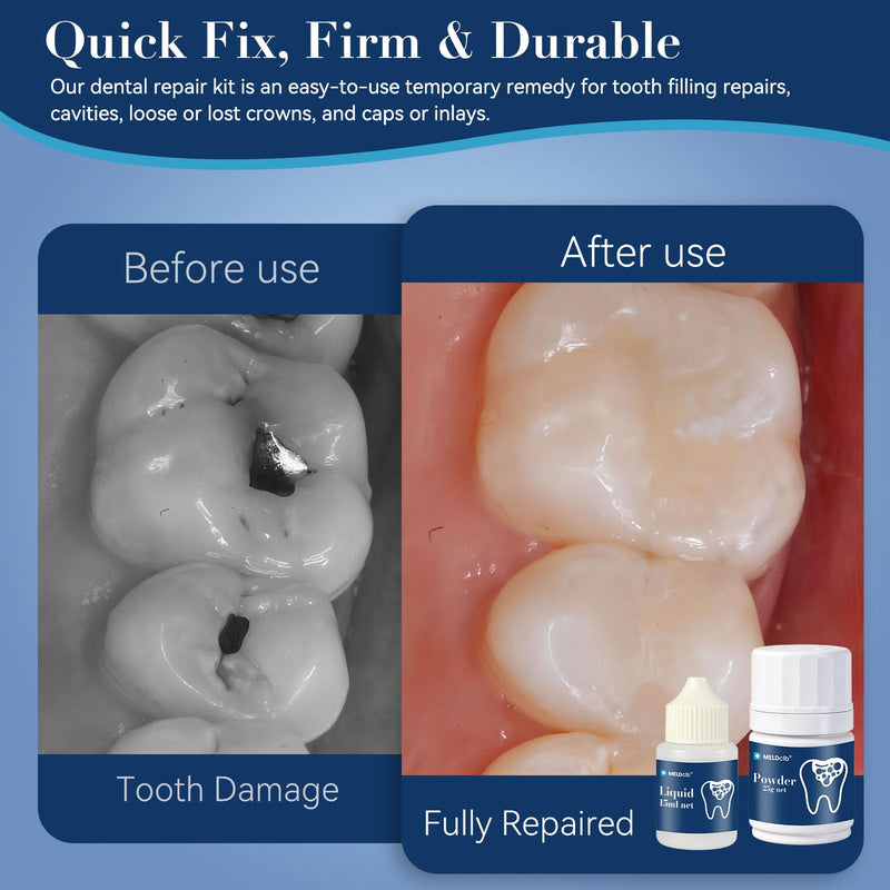 Zinc Oxide Eugenol Dental Care Kit, Tooth Repair Kit, Temporary Tooth Filling Repair Kit, Tooth Filler, Cavity Filler, Dental Cement Glue Adhesive for Crowns, Bridges, Teeth, Home Dental Emergency Fix 8 natural