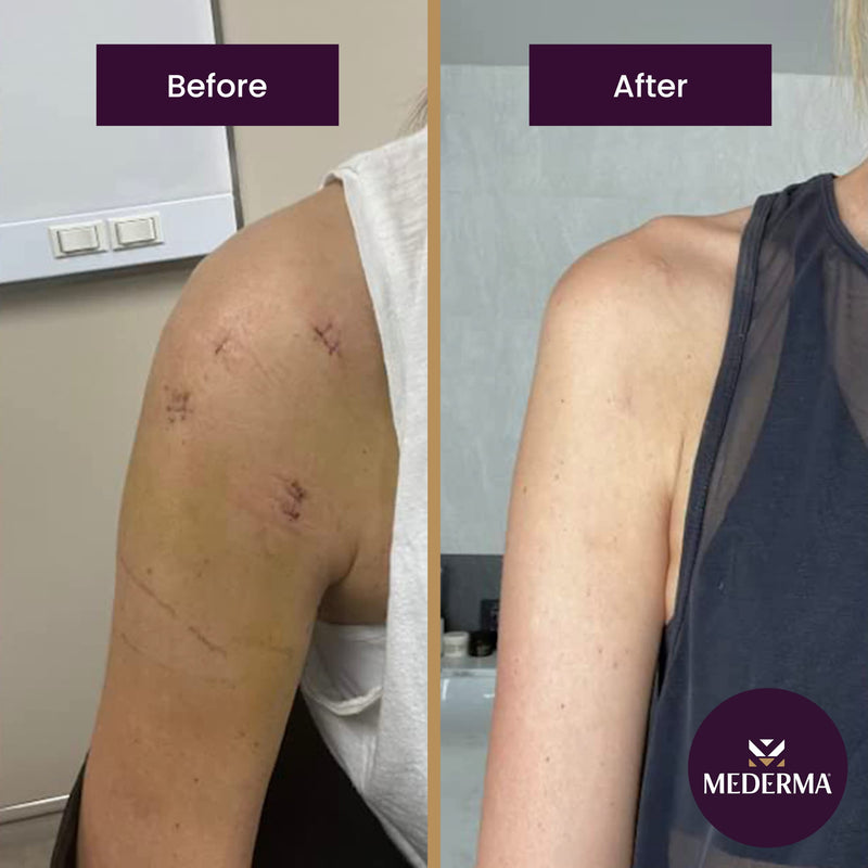 Mederma Advanced Scar Gel Quick Dry Oil Scar and Stretch Mark Treatment