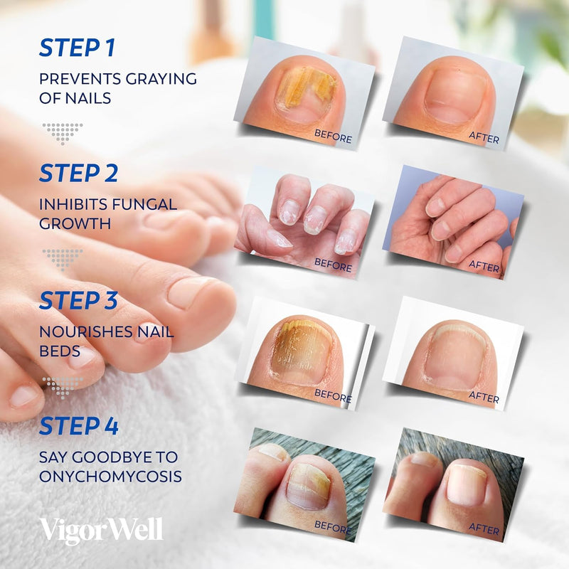 Toenail Fungus Treatment Extra Strength - Nail Fungus Treatment For Toenail Extra Strength - Nighttime Nail Patches & Nail Treatment Liquid Set (32patches+15ml)