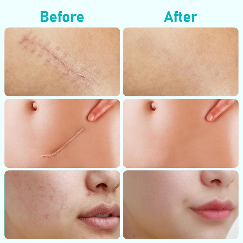 Advanced Scar Cream, Repair scar cream for Old and New Scars, Scar Removal Cream for Surgical Scars, Stretch Marks, C-Section, Keloids, Injury, Acne, and More 1.05 oz(30g)