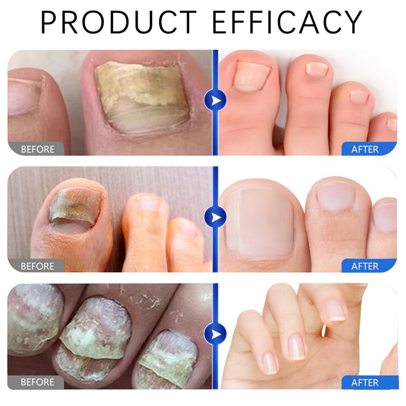Fungal Nail Patches, 7 Days Nail 𝐅𝐮𝐧𝐠𝐮𝐬 Treatment, Toenail Treatment Patches Extra Strength - 100% Pure Natural Plant extract Repair for Damaged Nails, Kerasal Toenail