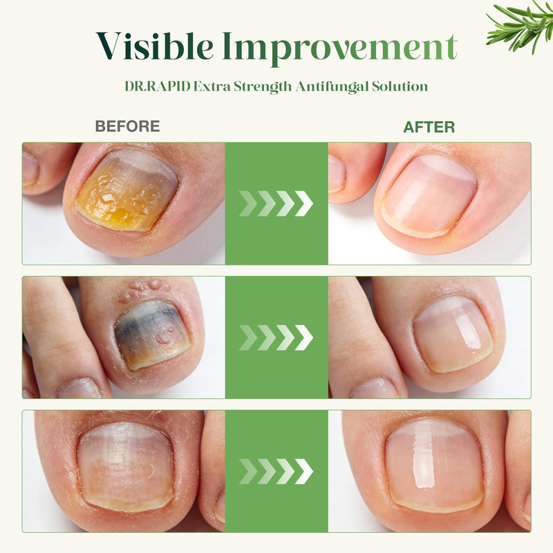 Toenail Fungus Treatment Extra Strength - Nail Repair for Damaged Nails, Nail Fungus Treatment Extra Strength with 25% Undecylenic Acid & Tea Tree Oil, Nail Repair for nail fungus treatment