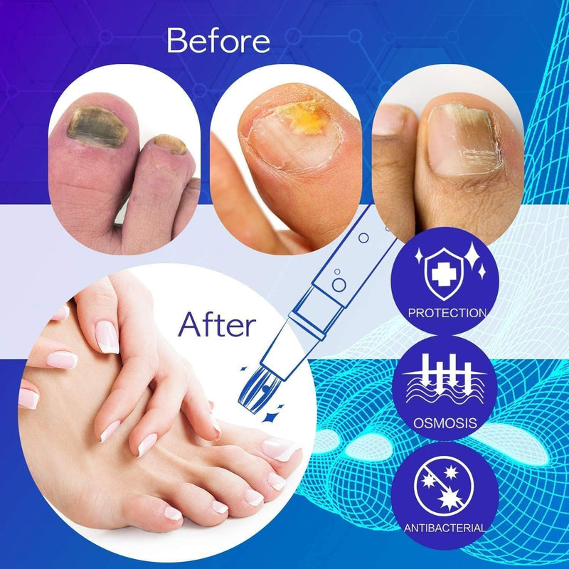 Nail Fungus Pen, Toenail Fungus Pen Treatment for Toenail & Fingernails, Nail Repair Pen For Nail Damage, Discoloration by Fungi - 2 pc 0.13 Fl Oz (Pack of 2) - BeesActive Australia