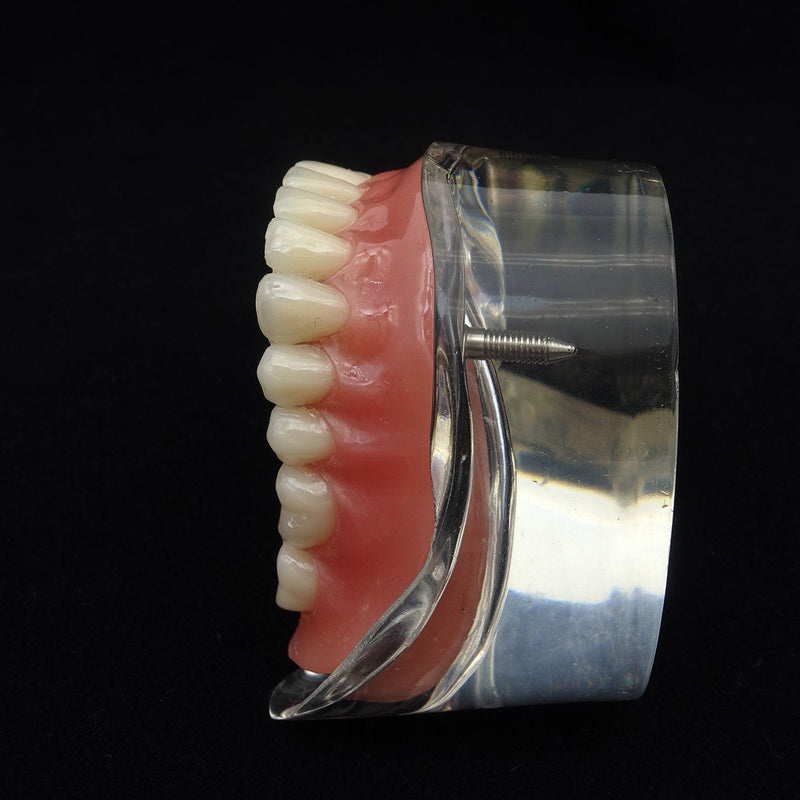 Dental Model Overdenture Inferior 2 Implants Demo for Studing and Teaching