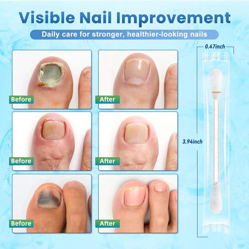 Fungal Nail Treatment Swabs–100 Ct, Extra Strength Toenail & Athlete’s Foot Fungus Treatment with 25% Undecylenic Acid, Damaged, Discolored & Thick Nails, Restores Healthy Nail Growth