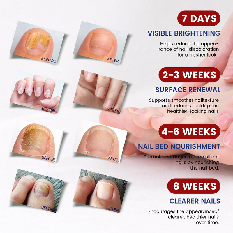 Toenail Fungus Treatment Extra Strength - 42 Pcs Fungal Nail Patches, 8-Hour Firm Adhesion, Nail Repair for Damaged Nails, Overnight Renewal for Men & Women (2 Count (Pack of 21)) 0.88 Ounce (Pack of 2) - BeesActive Australia