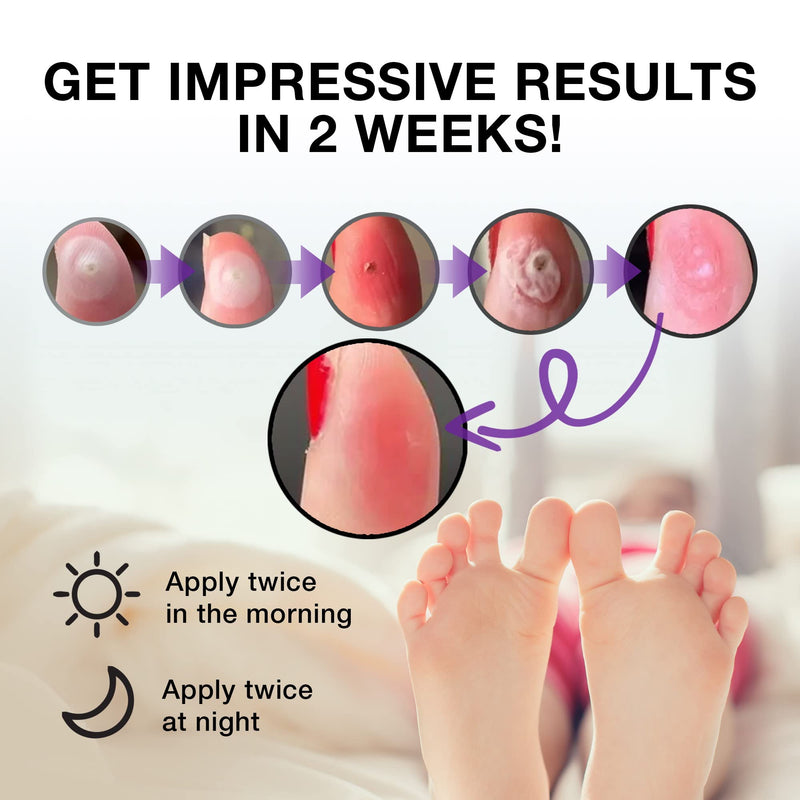 Wart Corn Removal for Feet: Salicylic Acid Plantar Wart Corn Remover Treatment for Toes Foot fingers hands - BeesActive Australia