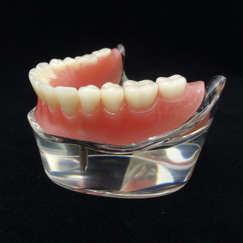 Dental Model Overdenture Inferior 2 Implants Demo for Studing and Teaching