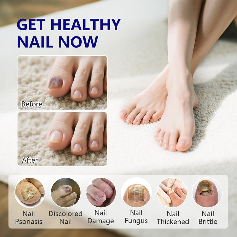 4-PACK Nail Fungus Pen - Toenail Fungus Treatment Extra Strength 25% Undecylenic Acid, Fast-Acting 7 Days Toe Nail Fungus Treatments, Tea Tree Oil, Acetic Acid Nail Repair Pens for Damaged Nail