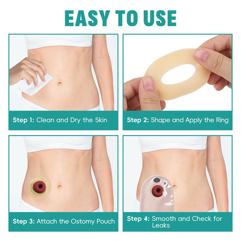 40Pcs Ostomy Barrier Ring - Outer Diameter 2" (50mm) 2mm Thickness,Moldable Ostomy Rings,Hydrocolloid Skin Extender Rings for Colostomy Bags 40 PCS - BeesActive Australia