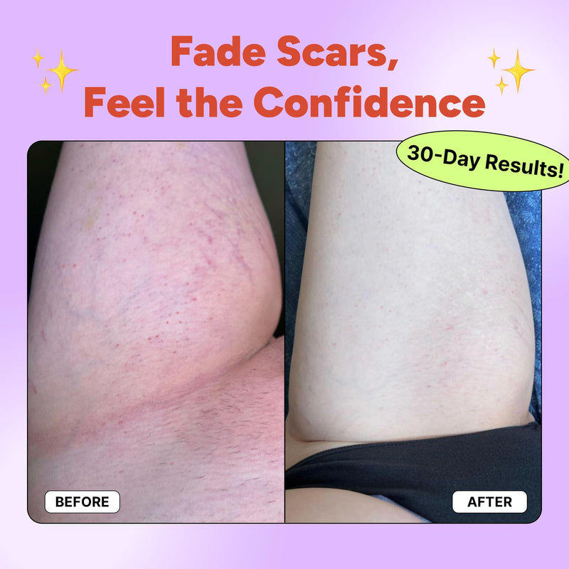 Scars Be Gone by OYO – Stretch Mark & Scar Cream for Body, Hips, Thighs & Stomach, Vitamin E + Citrus Brightening Lotion for Women, 50 mL - BeesActive Australia