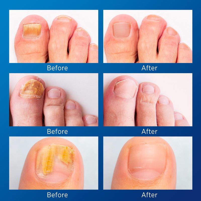 Small Nail Patches Extra Strength: 32 PCS Nighttime Hydrogel Patches for Overnight Repair - Visible Results in 8 Hours - Toenail Treatment Extra Strength - BeesActive Australia