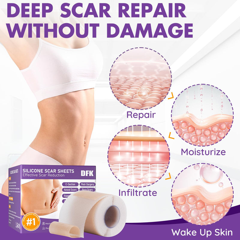 Silicone Scar Sheets, Silicone Scar Tape, Reusable Professional Scar Silicone Strips, Soft Silicone Scar Sheets for Surgical Scars,Keloid,Acne Scars,Burn Scar,C-Section (5M) 5M - BeesActive Australia