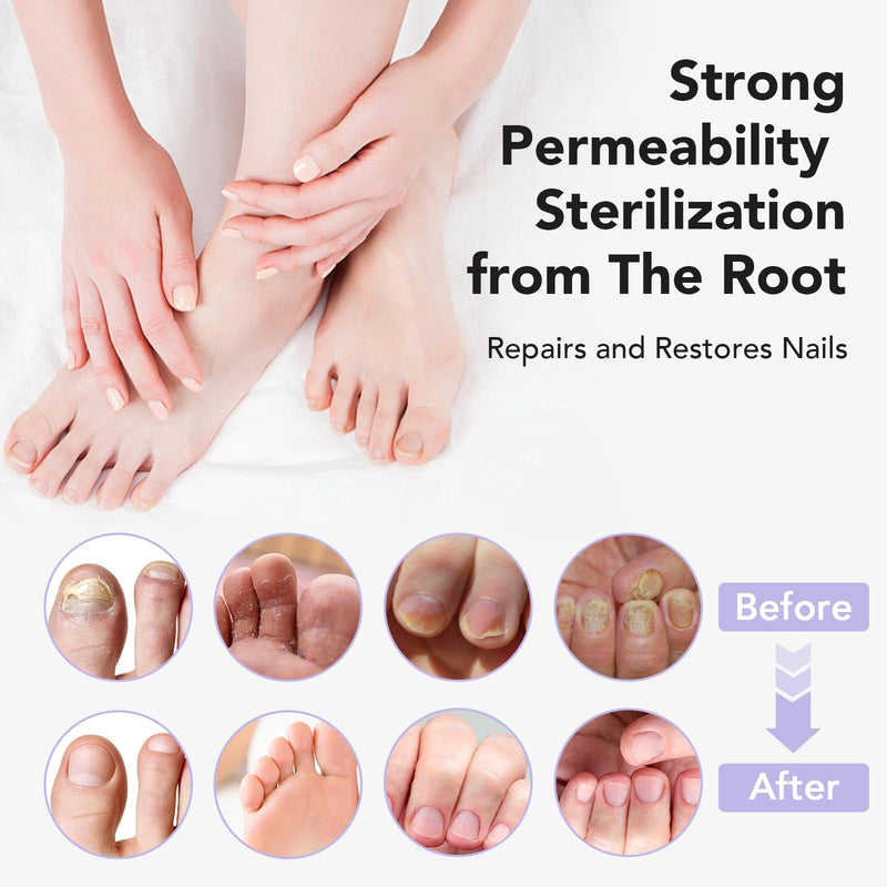 Toenail Fungus Treatment Extra Strength, Fungal Nail Treatment for Thick, Yellow, Discolored Nails,30ML 4 Weeks Toe Nail Fungus Treatment, Ingrown Toenail, Athletes Foot, Nail Growth & Strengthener 1 Fl Oz (Pack of 1)