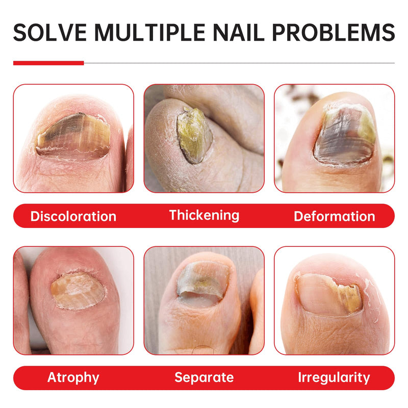Nail Fungus Treatment Extra Strength - 25% Undecylenic Acid, Gentle Plant Formula for Fingernails, Treats Under & Around Nail, Treatment Discoloration, Repair Thick, Damaged Nails, 2.02Fl.oz 2.02 Fl Oz (Pack of 1)