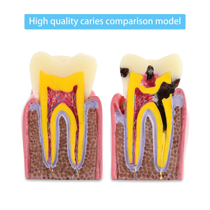 Dental Caries Tooth Model 6 Times Decay Teeth Comparative Study Model, Caries Bilateral Comparison Pathology Teeth Model Teaching Learning Tools for Dentist, Patient Education and Explanation - BeesActive Australia