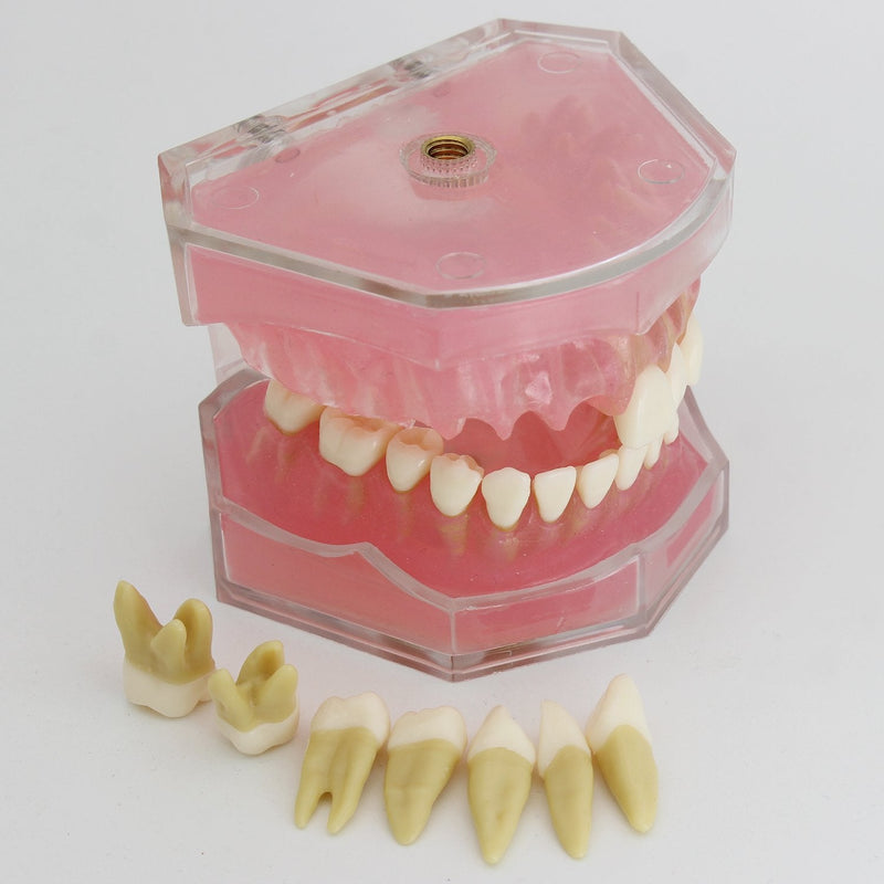Dental Implant Teeth Model with Removable Teeth for Dental Professionals and Students - BeesActive Australia