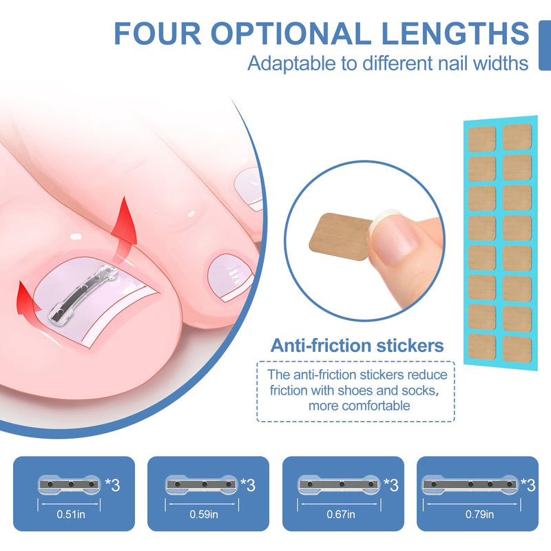 12Pcs Ingrown Toenail Corrector Strips for Curved Toenail Quick Relief,4 Multi-Sizes Ingrown Toenail Treatment Relief Tools Kit for Home Use