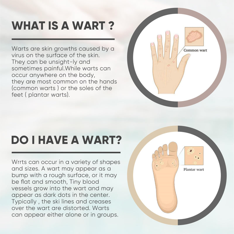 Wart & Corn Remover Liquid, Smoothes Skin Gentle Fast Acting Gel Wart Removal for Plantar Wart Flat Warts and Corns White - BeesActive Australia