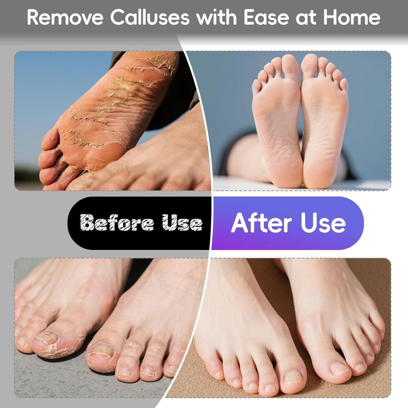Electric Foot Callus Remover with 60pcs Sandpaper Discs, 500RPM Aluminum 4.45 Inches Callus Remover for Feet, Feet File Grinder for Dead Skin and Calluses - BeesActive Australia