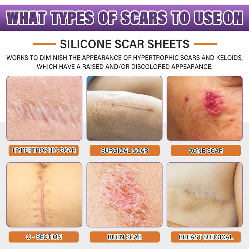 Silicone Scar Sheets,Silicone Scar Tape,Silicone Scar Removal Strips for Surgical,C-Section,Tummy Tuck,Keloid Scars (1.6"X 59" Roll-1.5M) Keloid Bump Removal 1.5M - BeesActive Australia