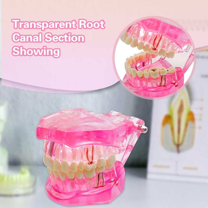 Transparent Disease Teeth Model with Dental Implant Bridge, Dental Teach Crown Bridge Removable Model, Tooth Model for Patient and Dental Student Education. (Red) Red - BeesActive Australia