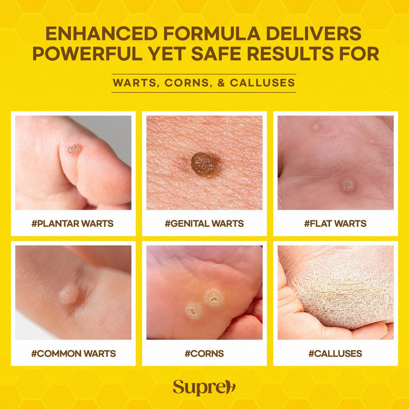 SupreH Bee Venom Wart Remover Kit: Maximum Strength Bee Venom Wart Solution with Botanical Skin Restore Cream - for Plantar and Common Wart 30 21 ML - BeesActive Australia