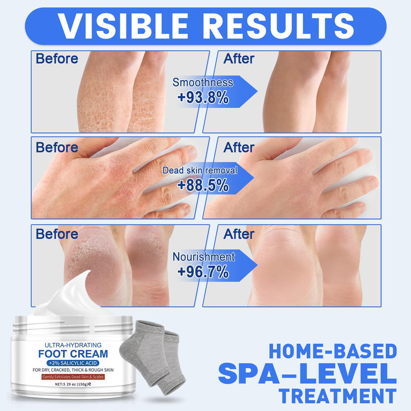 TEAWOO Ultra-Hydrating Urea Cream (Urea Conc. 40.67%), Foot Cream for Dry Cracked Heels and Feet, Pair with Moisturizing Heel Socks for Cracked Heel Treatment, Heel Socks Included (5.29 OZ/150g) Bundle - Foot Cream + Heel Socks - BeesActive Australia