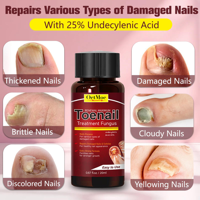 Toenail Fungus Treatment Extra Strength, Nail Fungus Treatment for Yellow, Thick, Discolored, Broken Nails, Ultimate Fungal Nail Repair, Make Nails Look Healthier Stronger, 2 Bottles 1 Count (Pack of 2)
