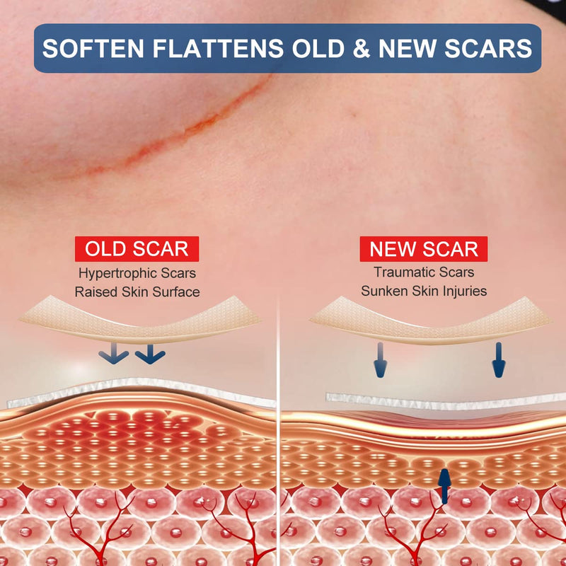 Silicone Scar Sheets for Breast - 8 Pack, Including 4 Areola Soft Strips & 4 Anchor Sheets - BeesActive Australia