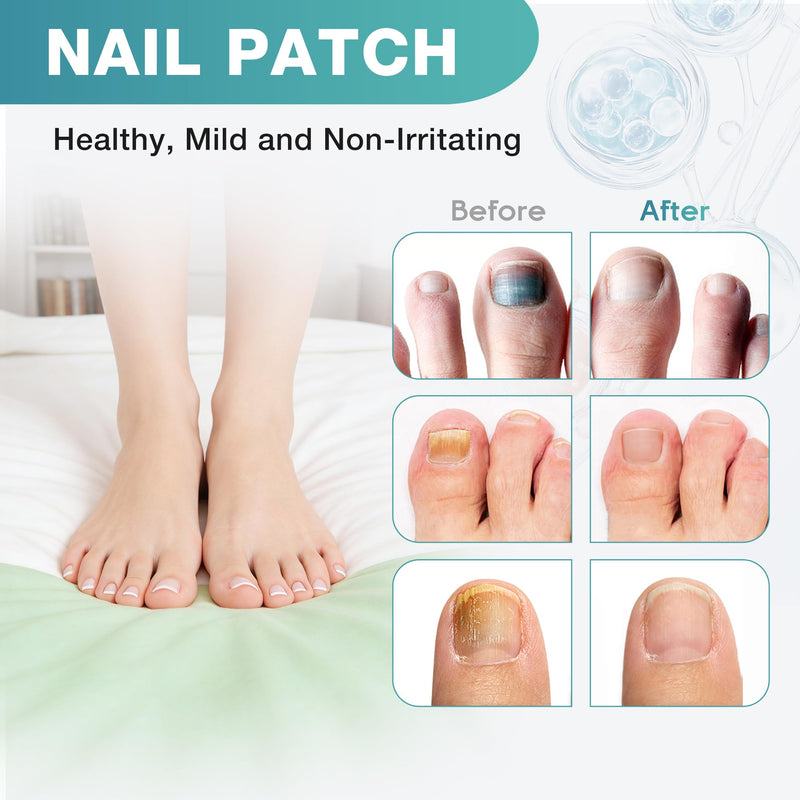 Fungal Nail Patches, Toenail Fungus Treatment Extra Strength - 20 Fungal Nail Patches for Toe Nail Fungus Treatments, 8-Hour Nighttime Nail Fungus Patches for Nail Fungus Treatment