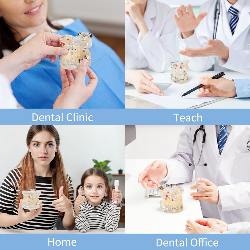 Annhua Transparent Disease Teeth Model for Dental Students, 32 Standard Removable Typodont Teeth Pathological Teaching Model - Ideal for Teaching, Not for Clinical Use Standard-Transparent Teeth Model - BeesActive Australia