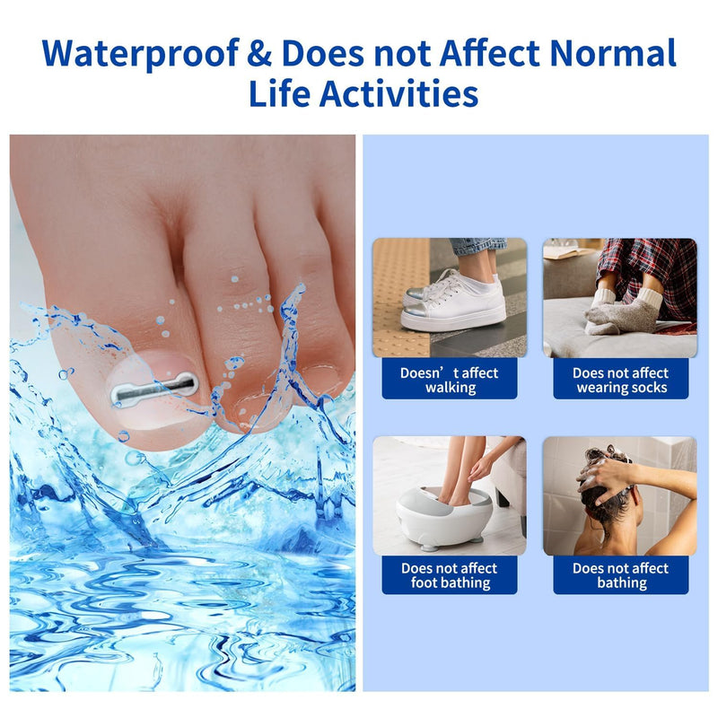 Ingrown Toenail Treatment, 10 packs Titanium Alloy Ingrown Toenail Corrector for all size foot, Ingrown Toenail Removal Kit for Curved Nail Repair, at Home Nail Kit Tools-Blue03