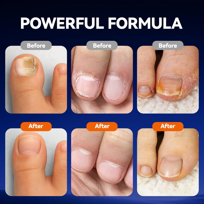 Toenail Fungus Pen, Nail Repair Pen for Damaged Nails, 25% Undecylenic Acid Formula,Tea Tree Oil, Extra Strength Toenail Fungus Treatment, Brittle & Discoloration Nails-5count-5ml/0.1FL OZ - BeesActive Australia