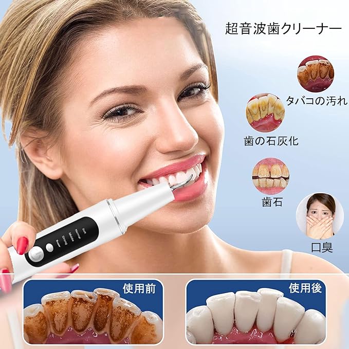 UJHOSLD Ultrasonic Tooth Cleaner, Oral Cleaner, USB Rechargeable, Ultrasonic Vibration, Portable Teeth Cleaner, 5 Modes Adjustable, Built-in LED Lighting, Cleaning Kit, IPX6 Waterproof, Portable and - BeesActive Australia