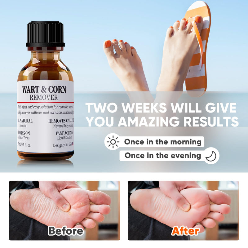 Wart & Corn Remover Liquid, Smoothes Skin Gentle Fast Acting Gel Wart Removal for Plantar Wart Flat Warts and Corns White - BeesActive Australia