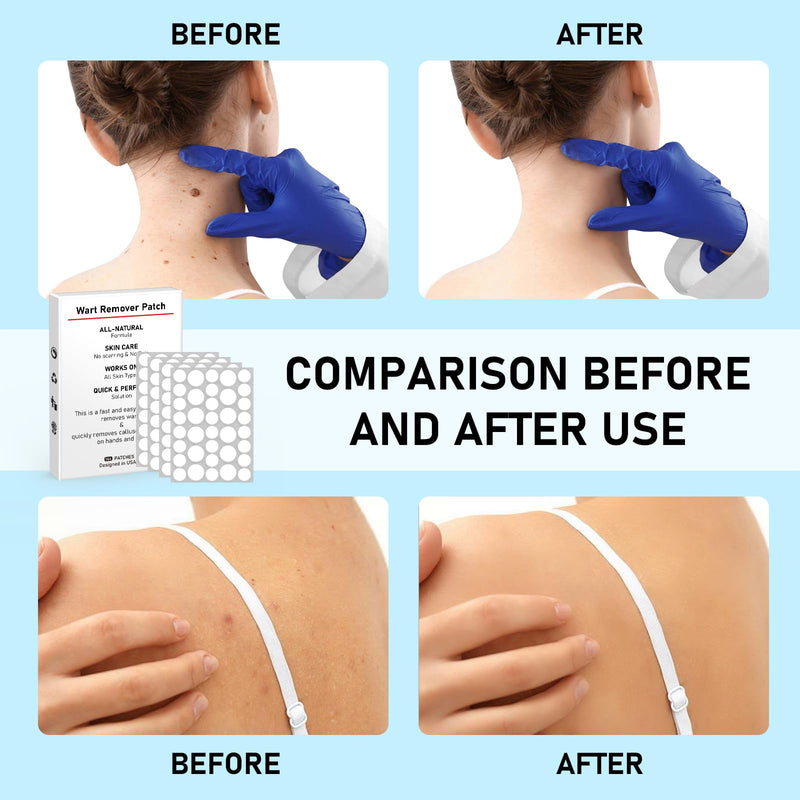 WABRINY Wart Remover Patches, Fast & Easy Operate Hydrocolloid Gel Waterproof Invisible Sticker, Skin Care Removal Patches, Friendly to New-User -CM White 144 Count (Pack of 1)