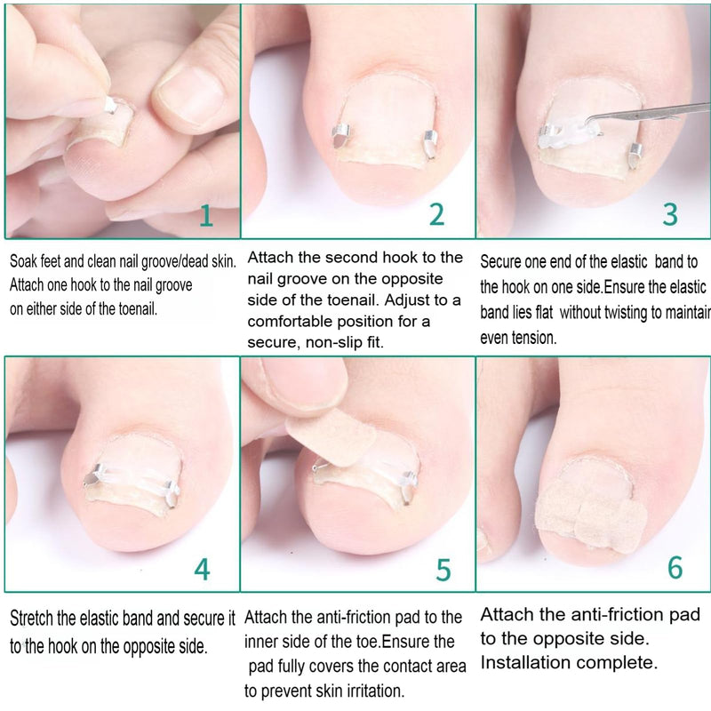 Ingrown Toenail Corrector Kit for Men Women - Ingrown Nail Tool - 2 Stainless Steel Clips- Curved Nail Strips & Toe Pads for Embedded/Curled Nails