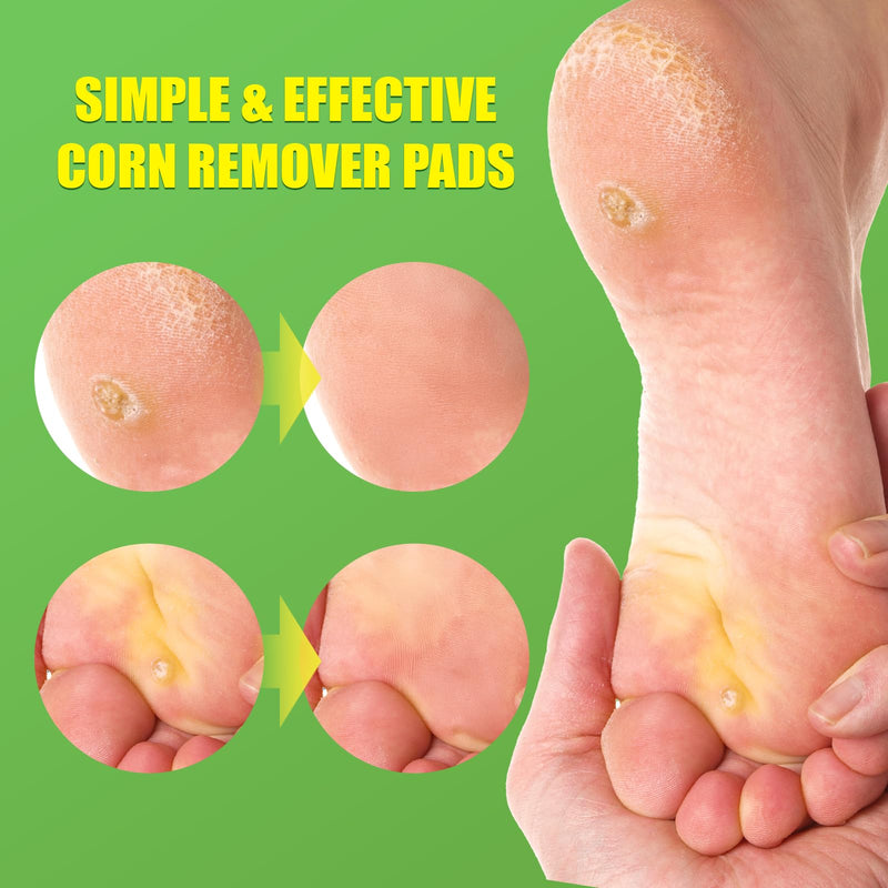 WABRINY Maximum Strength Corn Removers Pads for Feet and Toes, Fast Effective Foot Corn Removal Bandages for Kids Adults, All-Day Pain Relief, 30 Pack 30 Count (Pack of 1) - BeesActive Australia