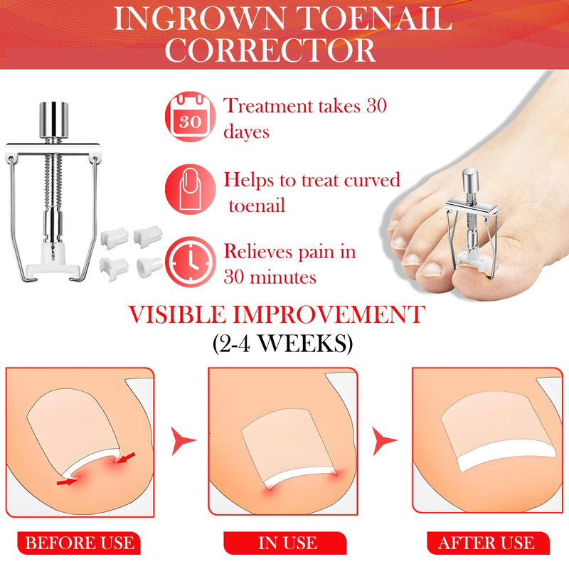 Ingrown Toenail Removal Kit, Professional Ingrown Toenail Treatment, Ingrown Toenail Tools Kit with Ingrown Toenail Corrector Drops, Toenail Clipper, Corrector Patch, Stainless Steel Pedicure Tool Set - BeesActive Australia