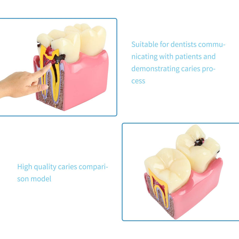 Dental Caries Tooth Model 6 Times Decay Teeth Comparative Study Model, Caries Bilateral Comparison Pathology Teeth Model Teaching Learning Tools for Dentist, Patient Education and Explanation - BeesActive Australia