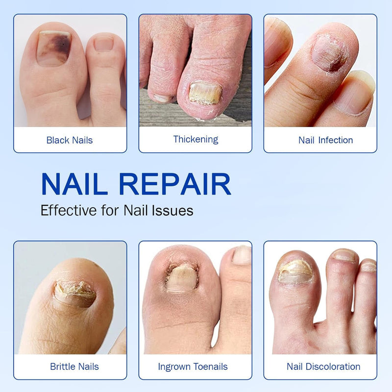 Toenail Treatment Extra Strength, Nail Repair Patches, Overnight Nail Fast Acting Repair, Improves Texture, Restore Discoloration and Thickness, Easy To Use 21 PCS - BeesActive Australia