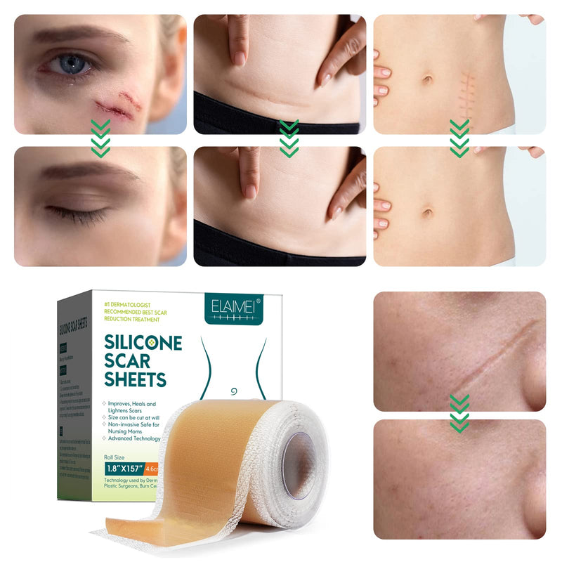 Silicone Scar Sheets(1.8‚Äù x 157‚ÄùInch- 4M), Scar Tape, Scar Strips, Medical Grade, Scar Remover, C-Section, Surgery, Keloid, Tummy Tuck, Scar Patch. - BeesActive Australia