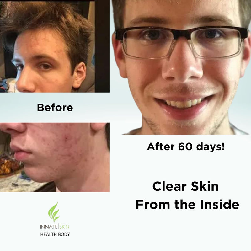 Clear Skin Acne Vitamin System | 20 Antioxidants, Botanicals & Minerals | 60 Count | Pack of 4 | 240 Total Capsules 60 Count (Pack of 4)
