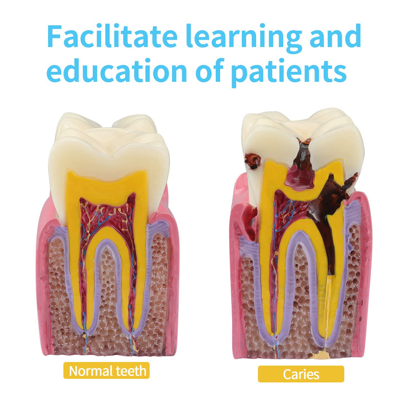 ANNWAH Dental Caries Teeth Model,Dental Anatomy Education Tooth Model,6 Times Caries Teaching Typodont Tool for Dentists, Patients, Teachers and Students - BeesActive Australia