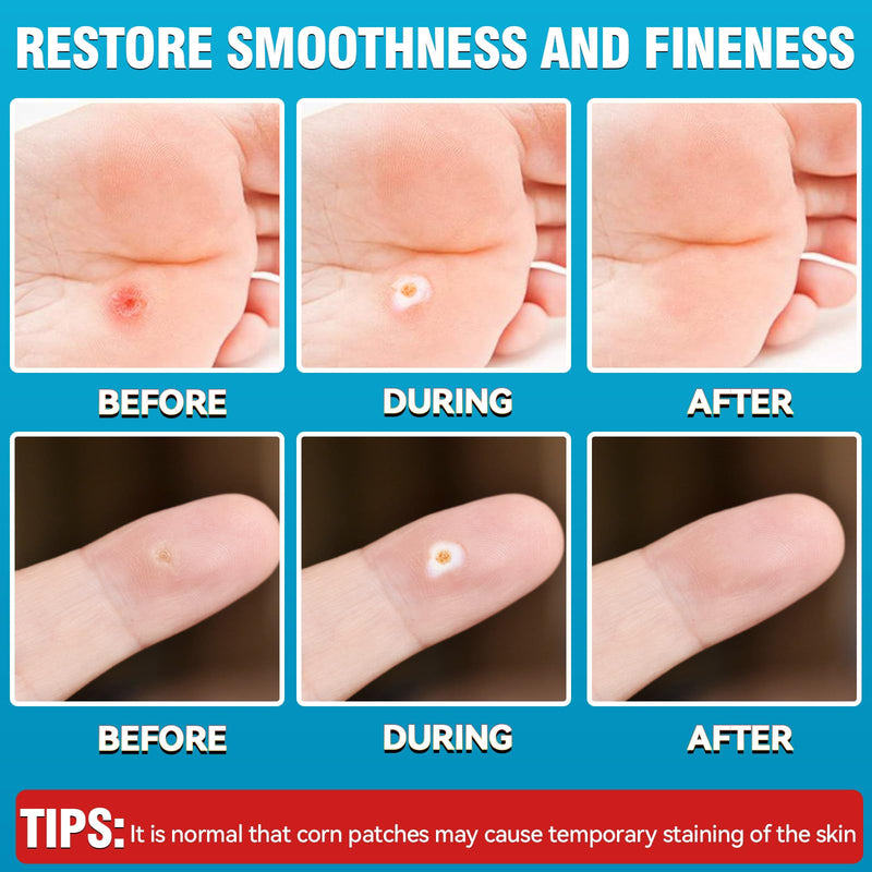 AstraVox 24Pcs Corn Removers for Toes Feet with Adhesive PU Waterproof Membrane, Plantar Corn Remover Bandaid Pads Kit for Hand, Highly Effective, Pain Relief, Easy to Use (Large) Large - BeesActive Australia
