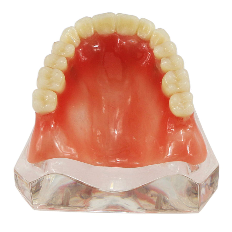 Dental Upper Implants Model Overdenture with 4 Superior Teeth Demo Transparent Vision for Education and Study Model Tool M6001 C